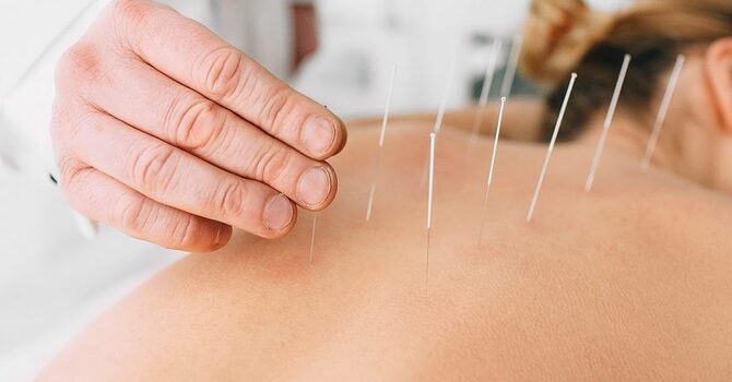 Acupuncture